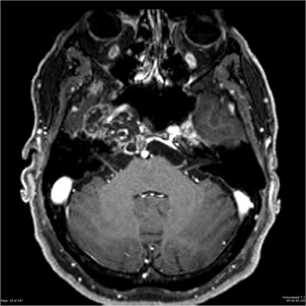 File:Chondrosarcoma of skull base- grade II (Radiopaedia 40948-43654 Axial T1 C+ 18).jpg