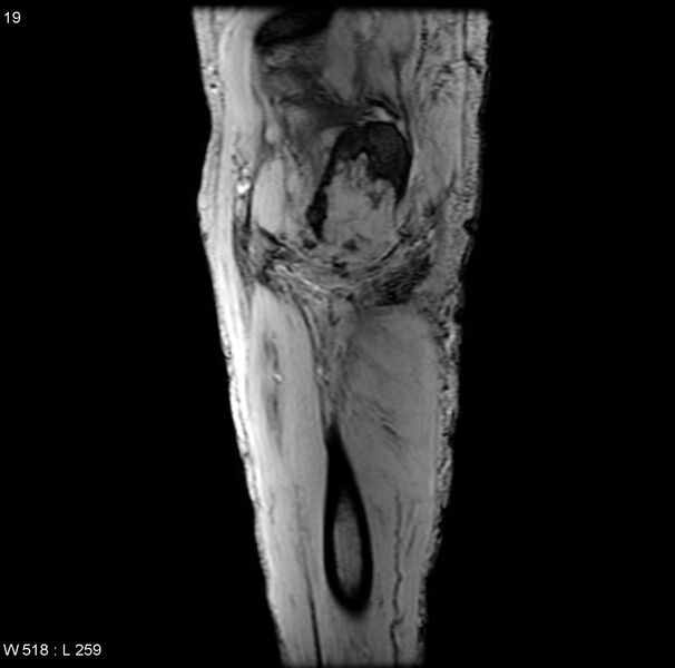 File:Chondrosarcoma with pathological fracture - femur (Radiopaedia 6174-7629 B 3).jpg