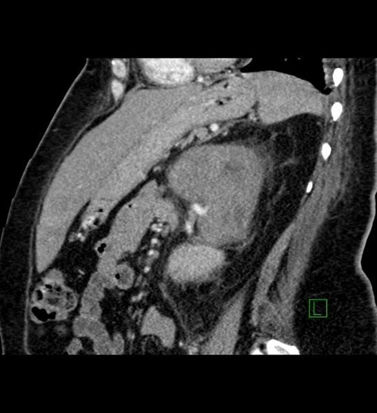 File:Chromophobe renal cell carcinoma (Radiopaedia 84239-99519 D 45).jpg