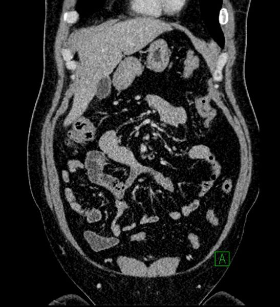 File:Chromophobe renal cell carcinoma (Radiopaedia 84286-99573 H 50).jpg