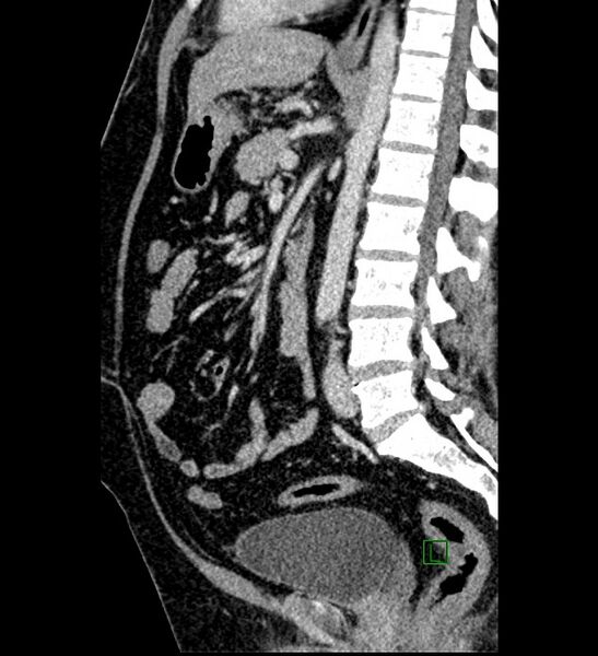 File:Chromophobe renal cell carcinoma (Radiopaedia 84286-99573 I 87).jpg
