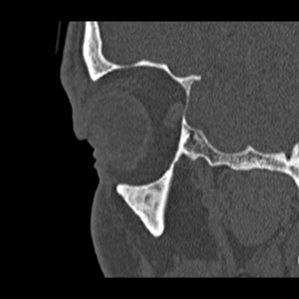 File:Chronic maxillary sinusitis (Radiopaedia 27879-28116 Sagittal bone window 3).jpg
