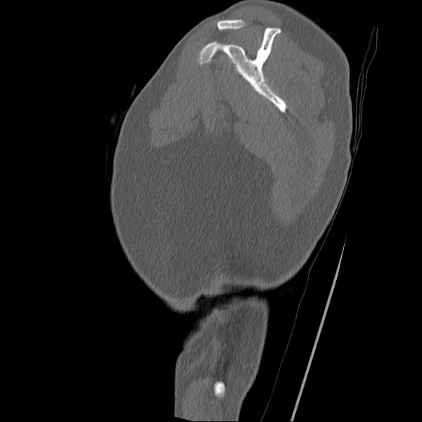 File:Chronic osteomyelitis (Radiopaedia 67597-76998 Sagittal bone window 1).jpg