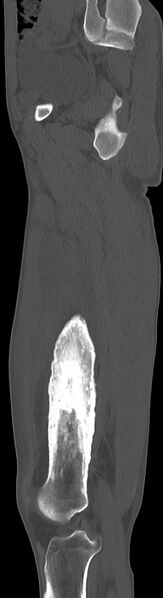 File:Chronic osteomyelitis (with sequestrum) (Radiopaedia 74813-85822 C 72).jpg