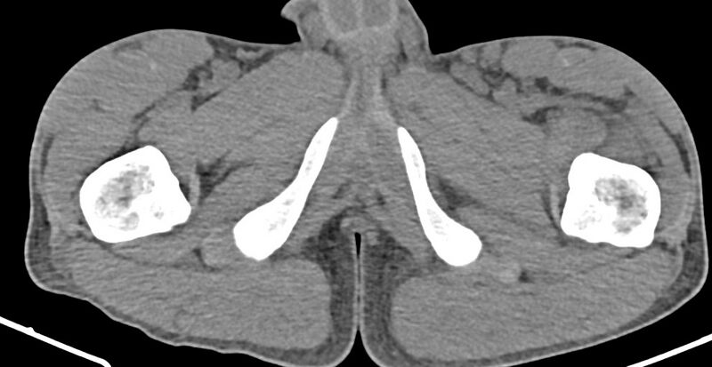 File:Chronic osteomyelitis (with sequestrum) (Radiopaedia 74813-85822 D 55).jpg