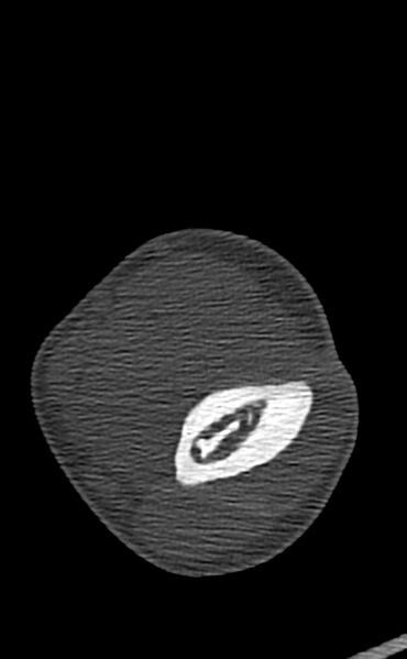 File:Chronic osteomyelitis of the distal humerus (Radiopaedia 78351-90971 Axial bone window 72).jpg