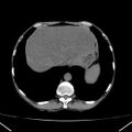 Chronic pancreatitis (Radiopaedia 23132-23172 Axial non-contrast 10).jpg