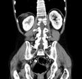 Chronic pancreatitis (Radiopaedia 23132-23172 C 45).jpg