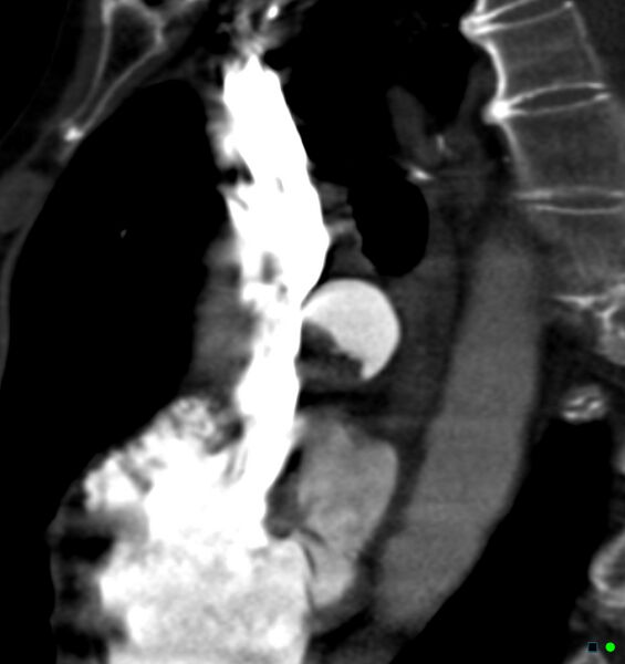 File:Chronic pulmonary embolism (Radiopaedia 17943-17702 Sagittal C+ CTPA 10).jpg
