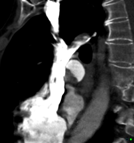 File:Chronic pulmonary embolism (Radiopaedia 17943-17702 Sagittal C+ CTPA 21).jpg