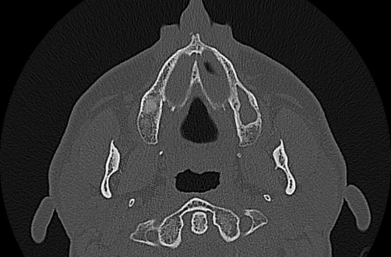 File:Chronic rhinosinusitis (Radiopaedia 65079-74075 Axial bone window 6).jpg