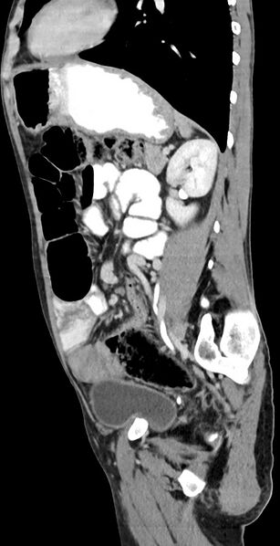 File:Chronic small bowel volvulus (Radiopaedia 75224-86322 C 55).jpg