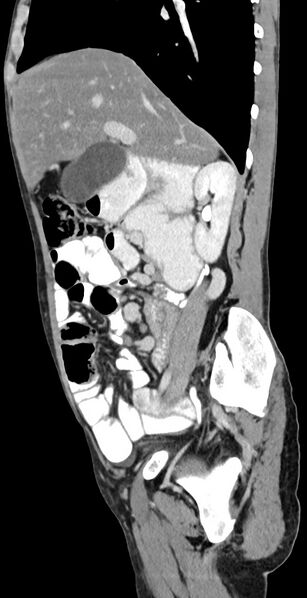 File:Chronic small bowel volvulus (Radiopaedia 75224-86322 C 96).jpg