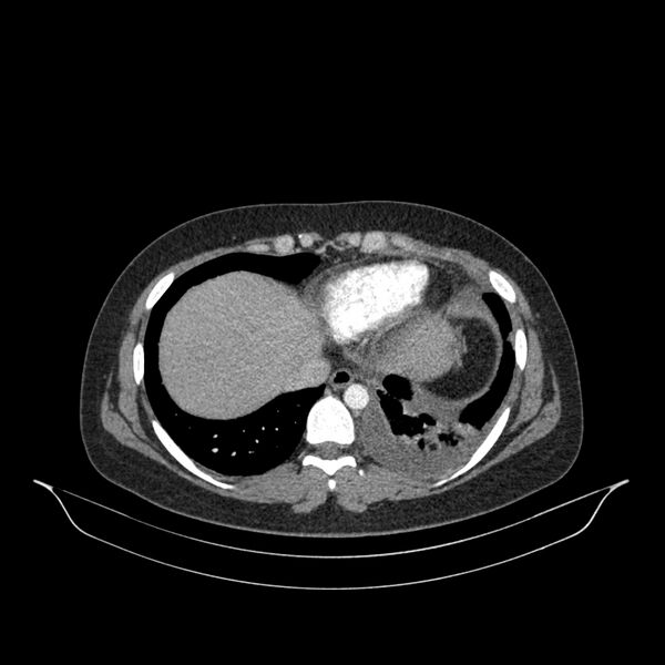 File:Chronic thromboembolic pulmonary hypertension (CTEPH) (Radiopaedia 74597-85532 Axial C+ CTPA 40).jpg