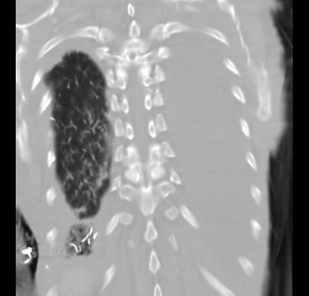 File:Clagett thoracotomy with bronchopleural fistula (Radiopaedia 29192-29587 Coronal lung window 3).jpg