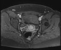 Class II Mullerian duct anomaly- unicornuate uterus with rudimentary horn and non-communicating cavity (Radiopaedia 39441-41755 Axial T1 fat sat 84).jpg