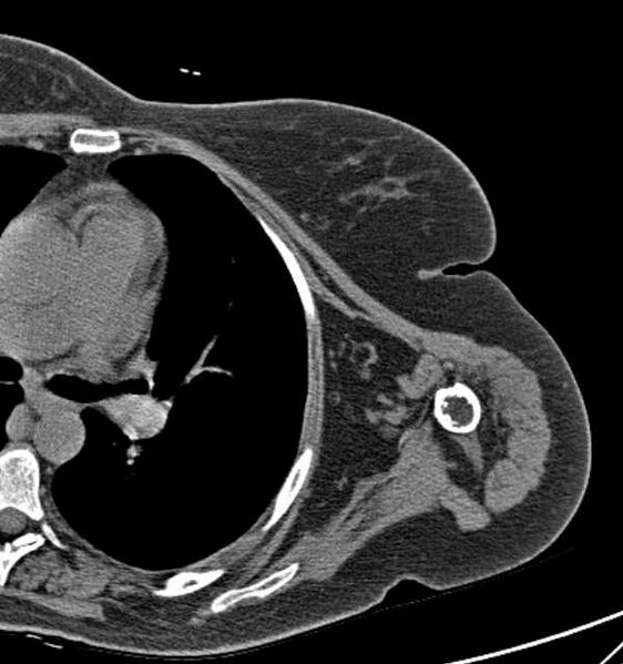 File:Clear cell chondrosarcoma - humerus (Radiopaedia 63104-71612 Axial non-contrast 77).jpg