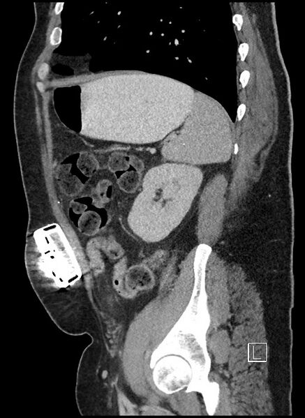 File:Closed loop obstruction - internal hernia into nephrectomy bed (Radiopaedia 59867-67320 C 17).jpg