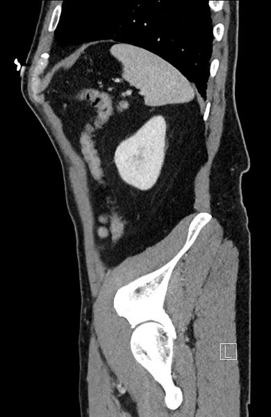 File:Closed loop small bowel obstruction - internal hernia (Radiopaedia 57806-64778 C 25).jpg