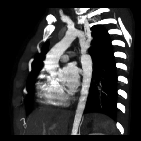 File:Coarctation of the aorta (Radiopaedia 6279-7684 Oblique MIP 1).jpg
