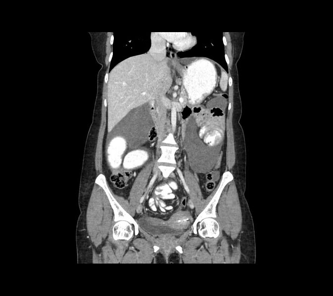 File:Cocoon abdomen with possible tubo-ovarian abscess (Radiopaedia 46235-50636 B 27).jpg
