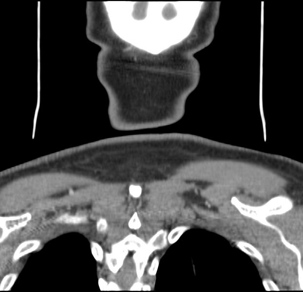 File:Colloid cyst of thyroid (Radiopaedia 22897-22923 Coronal C+ delayed 61).jpg