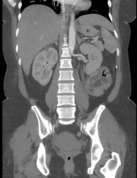 File:Colonic pseudo-obstruction (Radiopaedia 79752-92980 B 40).png