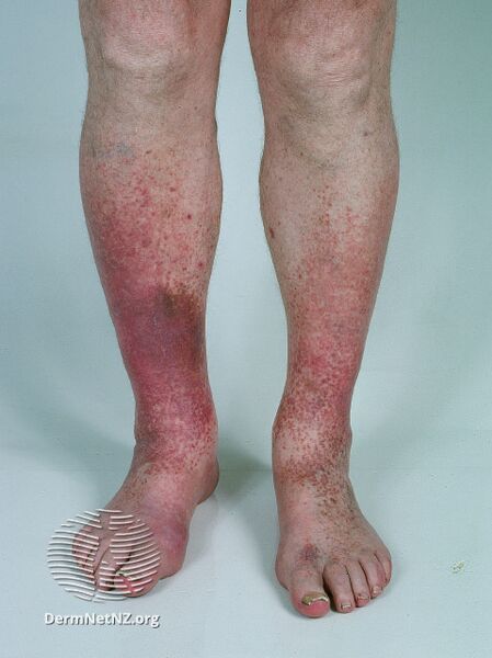 File:Lichen amyloidosis (DermNet NZ lichen-amyloidosis-21).jpg