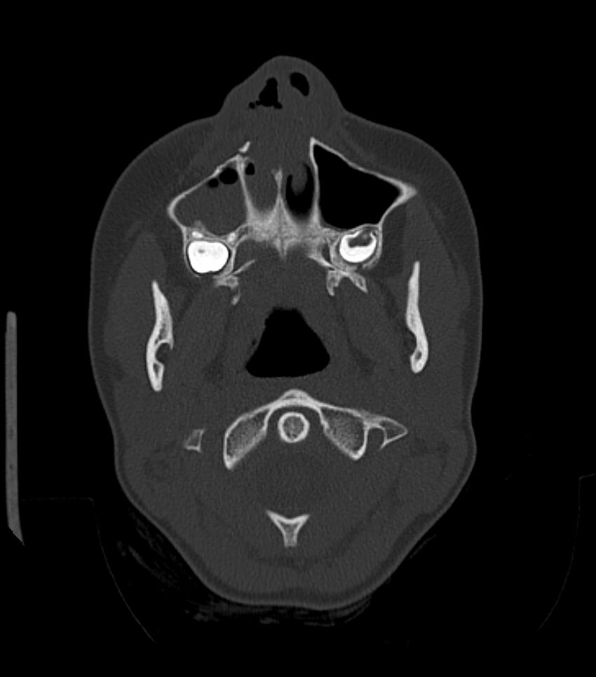 Nasoorbitoethmoid fracture (Radiopaedia 90044-107205 Axial bone window 54).jpg