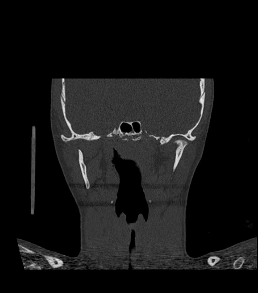 Nasoorbitoethmoid fracture (Radiopaedia 90044-107205 Coronal bone window 86).jpg