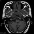 Nasopharyngeal carcinoma (Radiopaedia 4546-6667 Axial T1 7).jpg