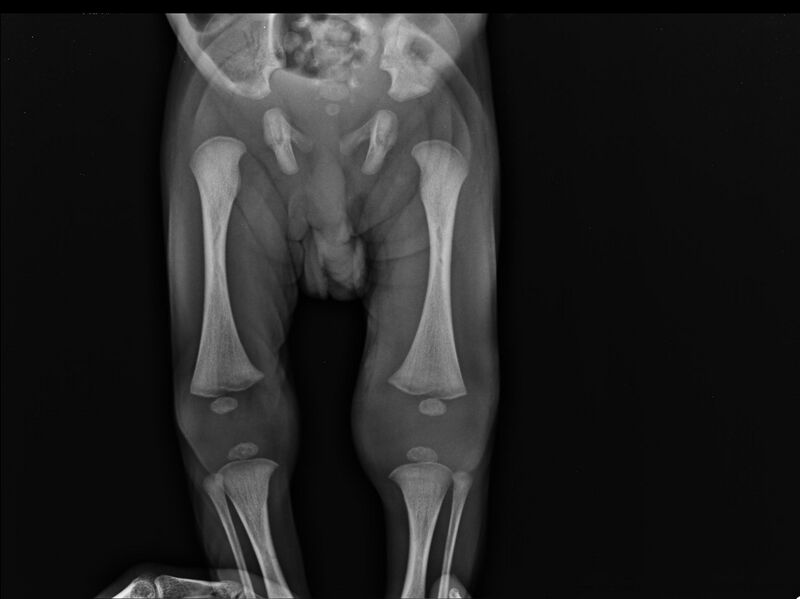 File:Neonatal knee septic arthritis (Radiopaedia 13358-13359 Frontal 1).jpg