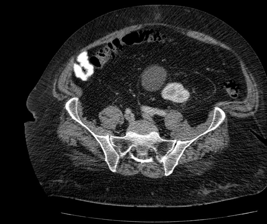 Nephroptosis with inguinal hernia containing perirenal fat (Radiopaedia 56632-63391 C 252).jpg