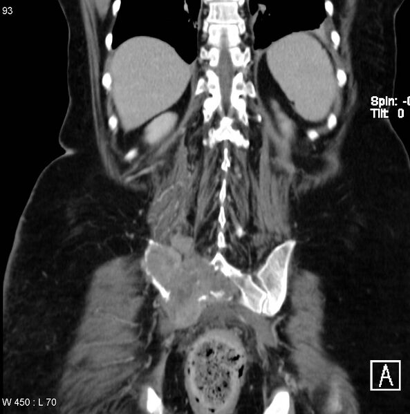 File:Nerve sheath tumor - malignant - sacrum (Radiopaedia 5219-6987 B 13).jpg