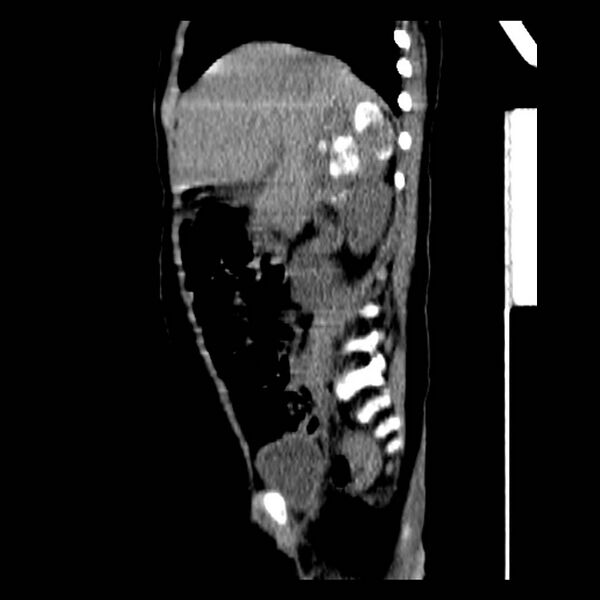 File:Neuroblastoma with skull metastases (Radiopaedia 30326-30960 B 15).jpg