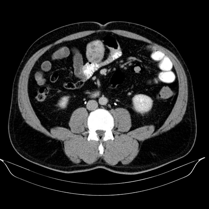 Neuroendocrine tumor of head of pancreas (Radiopaedia 57538-64502 D 47).jpg