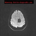 Neuroglial cyst (Radiopaedia 10713-11184 Axial DWI 28).jpg