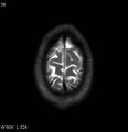 Neurosarcoidosis (Radiopaedia 10930-17204 Axial T2 19).jpg