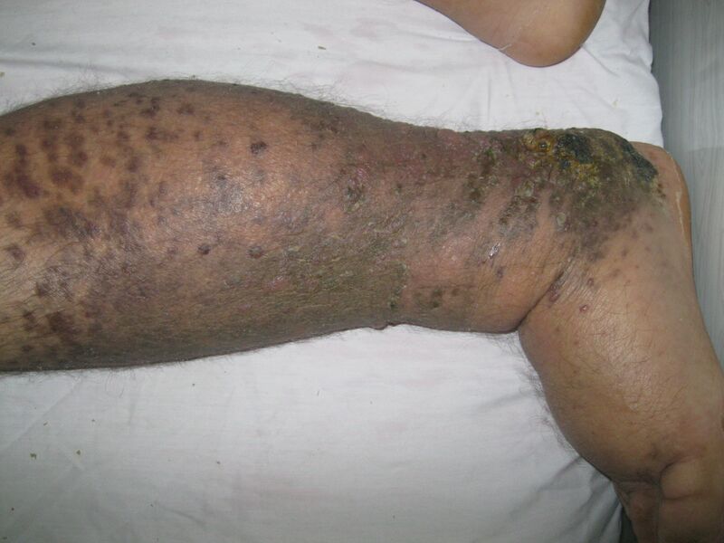 File:Non-AIDS associated Kaposi's sarcoma skin lesions (Radiopaedia 21810-21767 A 1).JPG