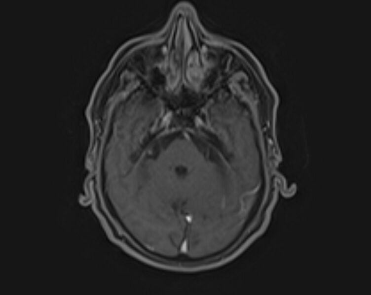 File:Non-Hodgkin lymphoma - parotid gland (Radiopaedia 71531-81890 E 23).jpg