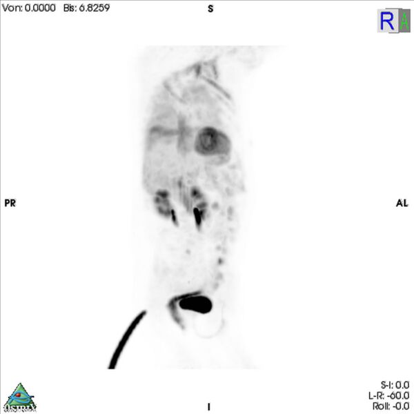 File:Non-Hodgkin lymphoma involving seminal vesicles with development of interstitial pneumonitis during Rituximab therapy (Radiopaedia 32703-33761 PET cor 3D MIP 11).jpg