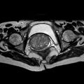 Non-puerperal uterine inversion (Radiopaedia 78343-90983 Axial T2 13).jpg