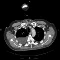 Non Hodgkin lymphoma in a patient with ankylosing spondylitis (Radiopaedia 84323-99624 B 8).jpg