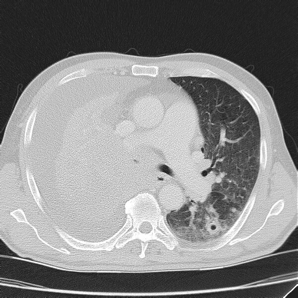 File:Non small-cell lung cancer (Radiopaedia 24467-24769 lung window 21).jpg
