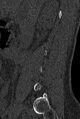 Normal CT lumbar spine (Radiopaedia 53981-60118 Sagittal bone window 11).jpg