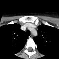 Normal CT of the neck (Radiopaedia 14575-14500 Axial C+ 74).jpg