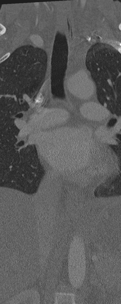 File:Normal CT thoracic spine (Radiopaedia 40181-42688 Coronal bone window 12).png