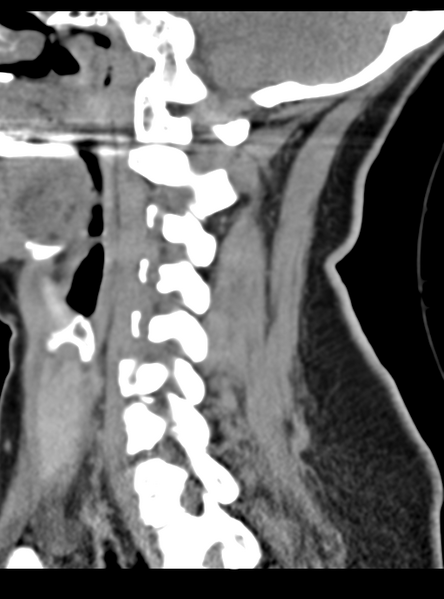 File:Normal cervical spine MRI (including Dixon) (Radiopaedia 42762-45926 C 39).png