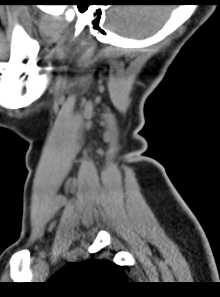 File:Normal cervical spine MRI (including Dixon) (Radiopaedia 42762-45926 C 5).png