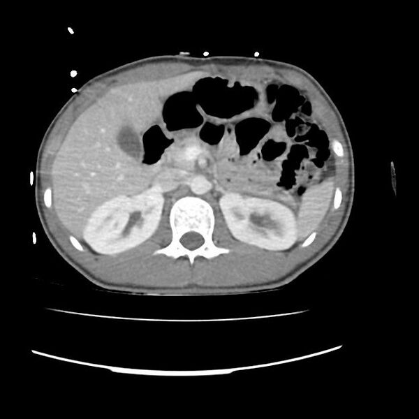File:Normal dual-phase trauma CT chest,abdomen and pelvis (Radiopaedia 48092-52899 A 60).jpg